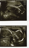 3rd Ultrasound 04